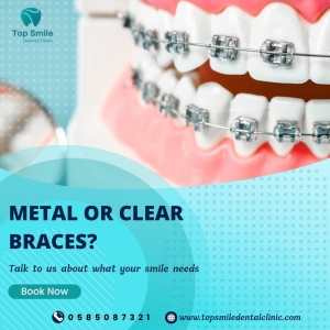 Affordable Braces Treatment in Dubai – Get a Perfect Smile at Top Smile Dental Clinic