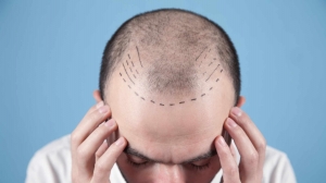 Hair Transplant Surgery Success Rate in Mumbai: What You Need to Know