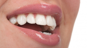 Who Is the Right Candidate for E-Max Veneers?