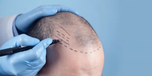 How Can One Get A Natural Looking Hair Transplant?