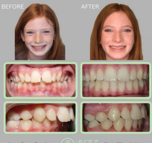 Choosing Between Braces and Invisalign in Kannapolis: What You Must Know
