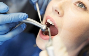 How Long Does a Root Canal Last?