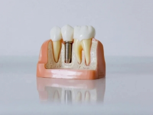 From Loose to Lasting: Dental Implants for Dentures