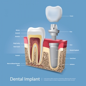 Are Dental Implants Safe? Your Safety Guide for a Secured Smile