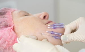 Achieve Natural Facial Lift Using Thread Lift Techniques