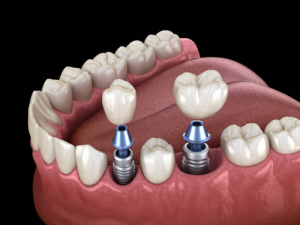 One Day Dental Implants That Change Fort Worth Smiles Fast