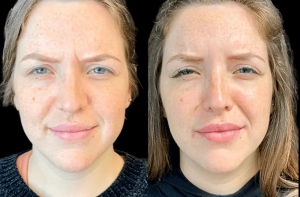 Natural-Looking Results: Expert Tips for Botox Treatments in Dubai