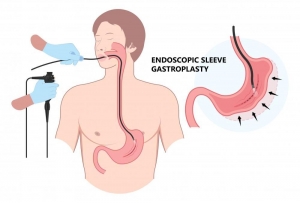 Understanding Endoscopic Sleeve Gastroplasty and How It Works