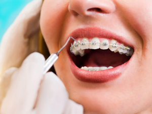 How Often Should I Visit the Orthodontist With Braces?