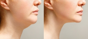 Double Chin Removal with High Success Rate in Islamabad