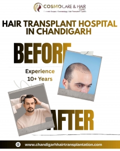 Finding the Best Hair Transplant Hospital in Chandigarh