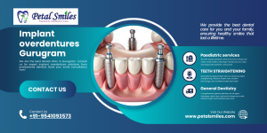 Implant Overdentures Gurugram