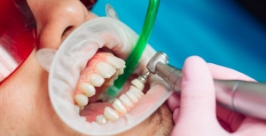 5 Surprising Benefits of Regular Teeth Cleaning in Marietta