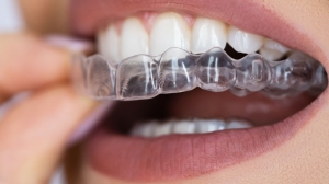 Thinking About Clear Aligners? What Garden Grove Patients Should Know Before Starting Treatment