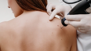 Can Laser Wart Removal Cause Scarring?