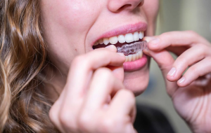 Invisalign Braces Treatment Cost That Defines True Confidence