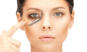 Safe and Effective Laser Treatments for Dark Circles in Riyadh