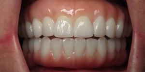 Why Are Dental Implants Recommended for Long-Lasting Results?:
