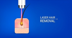 What are the Top Benefits of Laser Hair Removal Procedure?