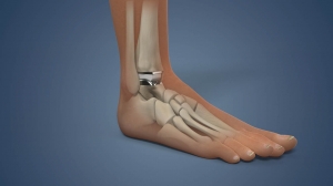 Say Goodbye to Ankle Pain with Total Ankle Replacement inDelhi
