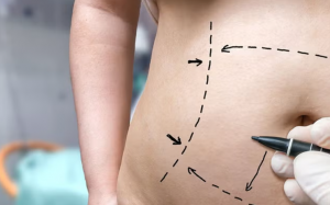 What Is a Tummy Tuck? Complete Beginner’s Guide