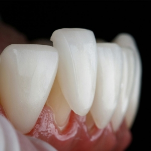 What Problems Do Composite Veneers Solve?