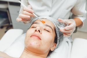 How Long Does a Chemical Peel Session Take?