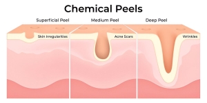 Top Benefits of Chemical Peel Treatment for Glowing, Even-Toned Skin