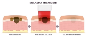 Understanding Melasma: Top Symptoms and Major Causes