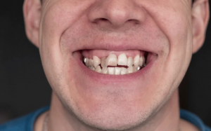 What Are the Cheapest Options for Crowded Teeth Treatment?