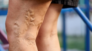 What Are the Biggest Benefits of Choosing Professional Varicose Vein Treatment?: