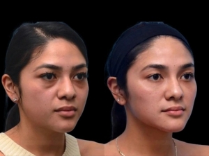 How the best plastic surgeon in dubai Achieves Natural-Looking Results for Dark Circles