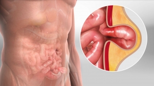What is a Hernia?
