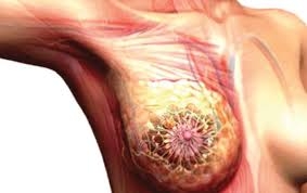 Breast Cancer Surgery