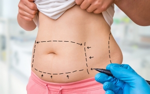 The Future of Liposuction: New Technologies Changing Body Sculpting