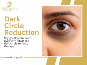 Dark Circles Treatment in Indore for Brighter, Youthful and Refreshed Under-Eye Skin