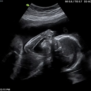 Why Are Parents Choosing Baby Scan Camden Services?