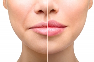 What Results Can You Expect from Dermal Filler Treatments?