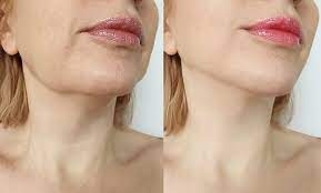 Crafting Elegance: Artistic Approach to Chin Liposuction