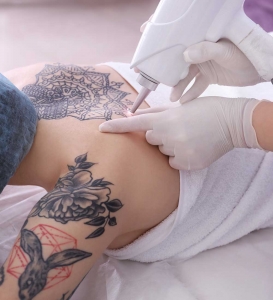 What Makes Laser Tattoo Removal a Popular Choice for Tattoo Correction?