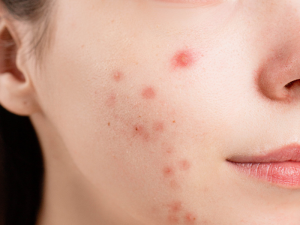 The Truth About Tiny Black Spots on Your Nose and How to Treat Them