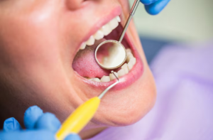 Dental Caries Treatment: Effective Ways to Protect Your Teeth and Prevent Decay