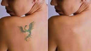 Beyond the Tattoo: Removal Considerations