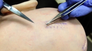 Suture Removal Hacks: How to Do It Yourself Like a Pro