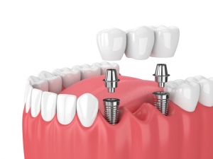 How long does the Typical Process for Receiving Dental Implants in West Houston Take?