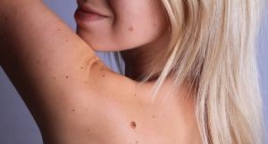 Skin Tag Removal for Sensitive Areas: Safety Tips and Options