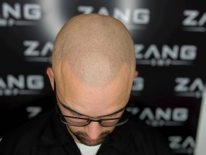 The Evolution of Scalp Micropigmentation Techniques