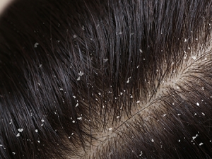 Unlocking the Benefits of Professional Dandruff Treatment in Pune