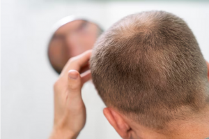 Effective Strategies for Combating Male Hair Loss