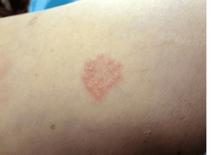 skin condition granuloma annulare treatment